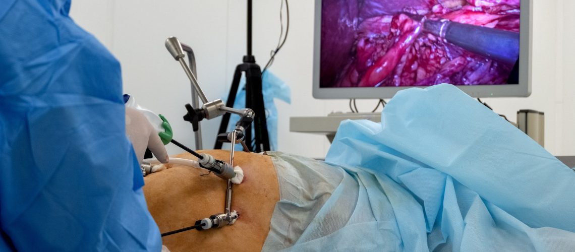 4-beneficios-da-cirurgia-videolaparoscopica